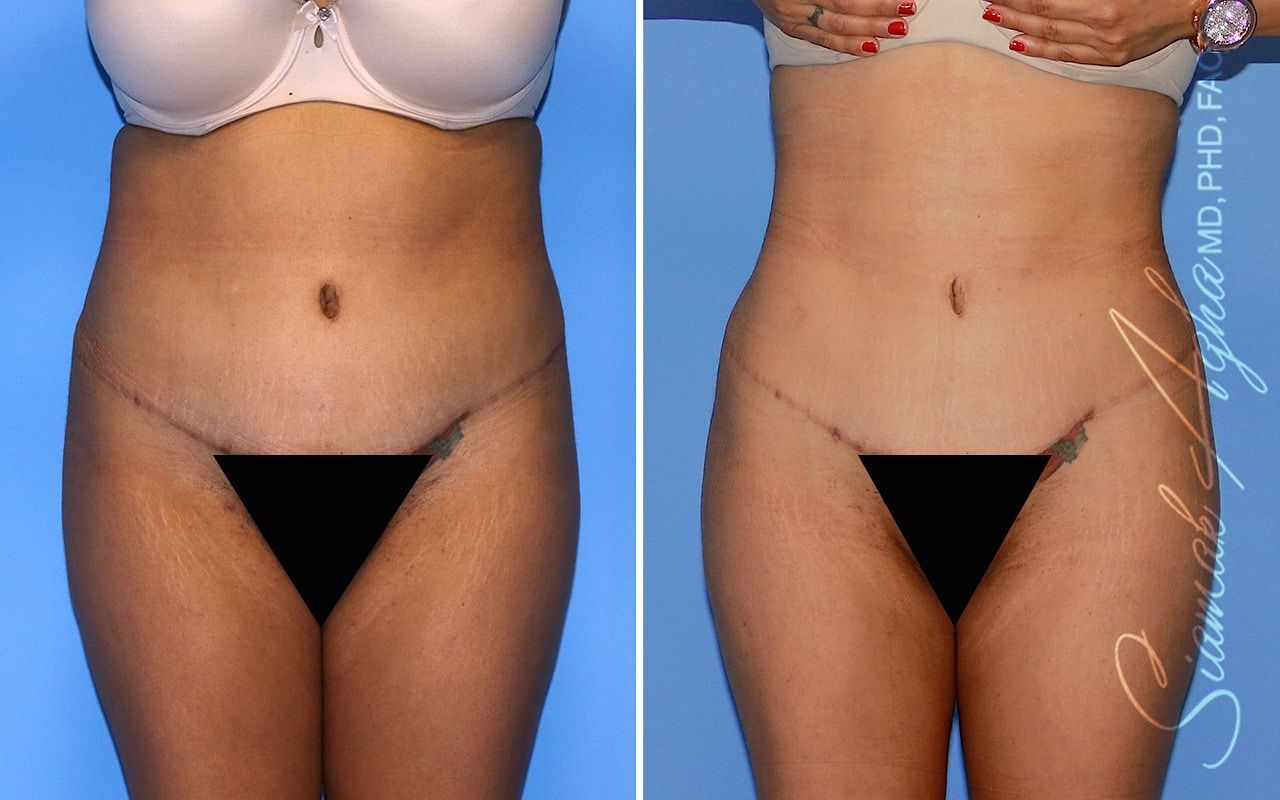 Brazilian Butt Lift Before & After