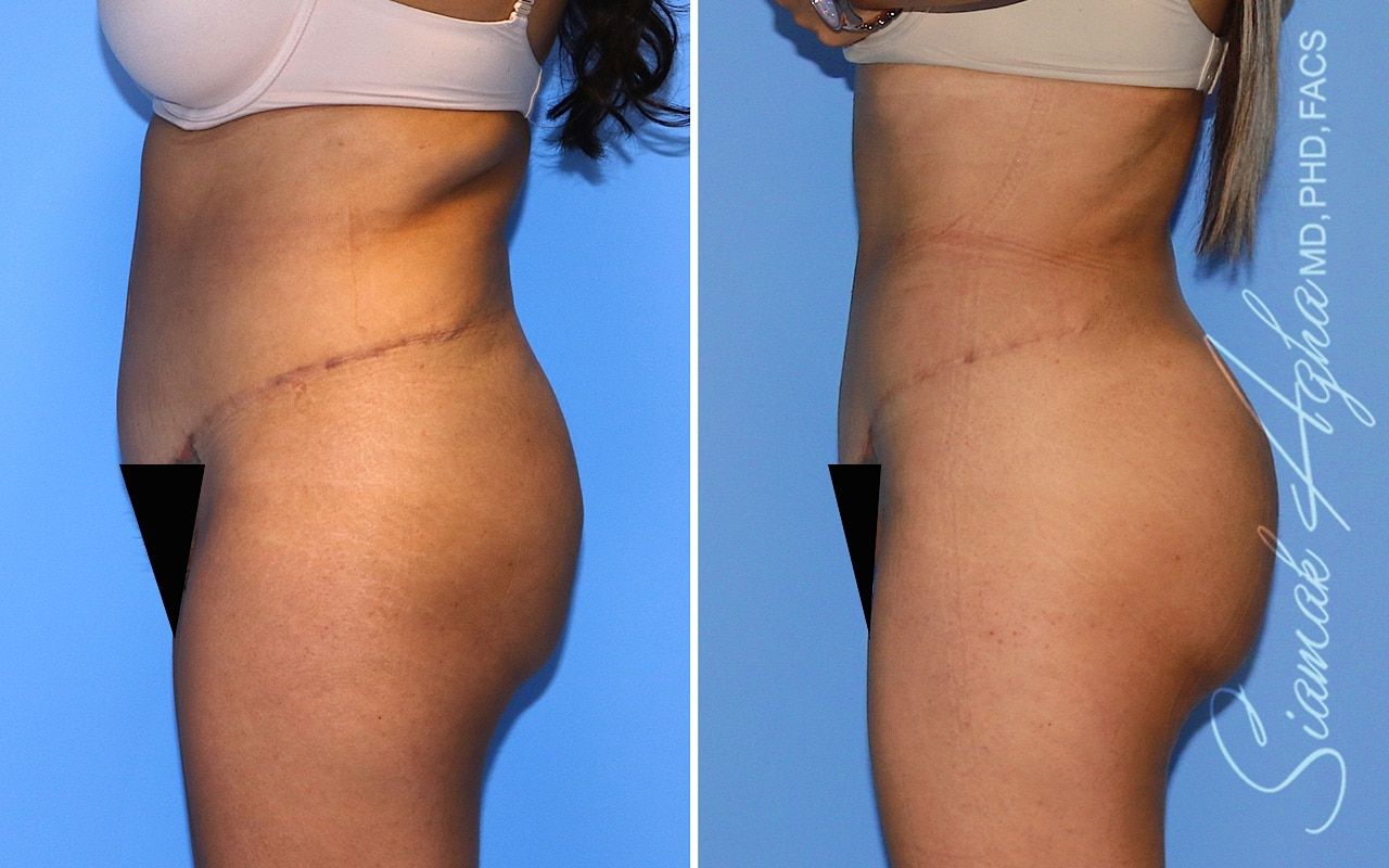 Brazilian Butt Lift Before & After