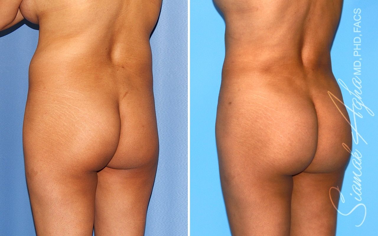 Brazilian Butt Lift Before & After