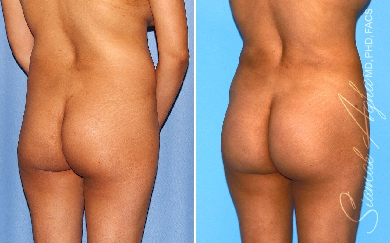 Brazilian Butt Lift Before & After
