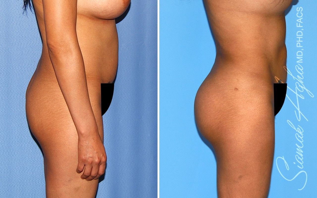Brazilian Butt Lift Before & After