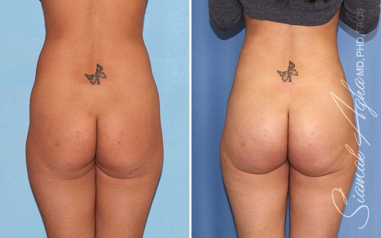 Brazilian Butt Lift Before & After