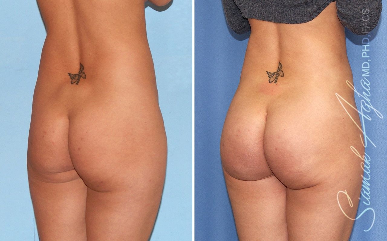 Brazilian Butt Lift Before & After