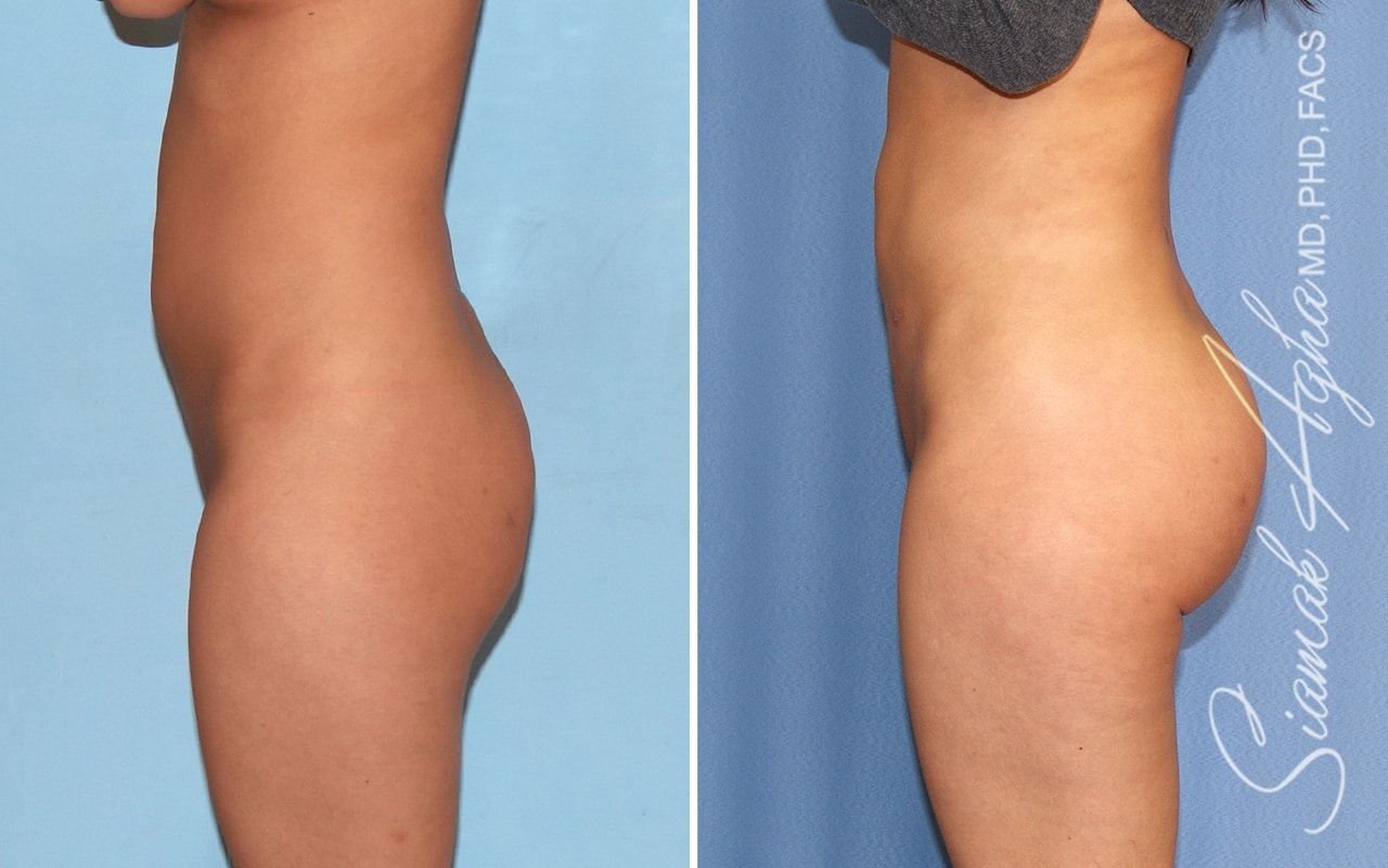 Brazilian Butt Lift Before & After