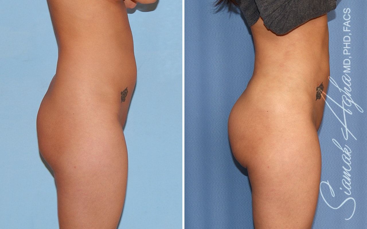 Brazilian Butt Lift Before & After