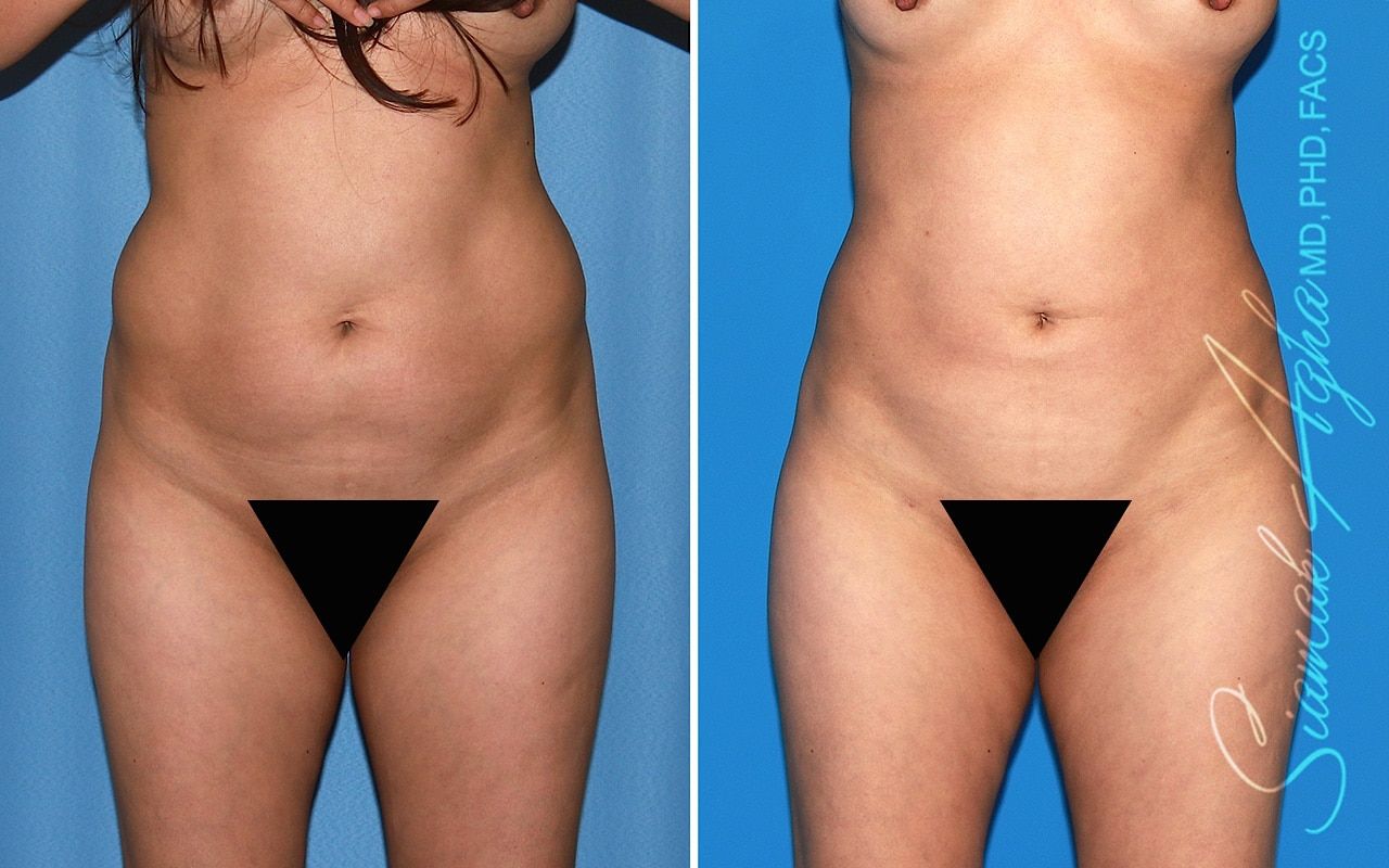 Brazilian Butt Lift Before & After