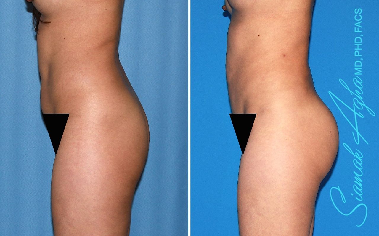 Brazilian Butt Lift Before & After