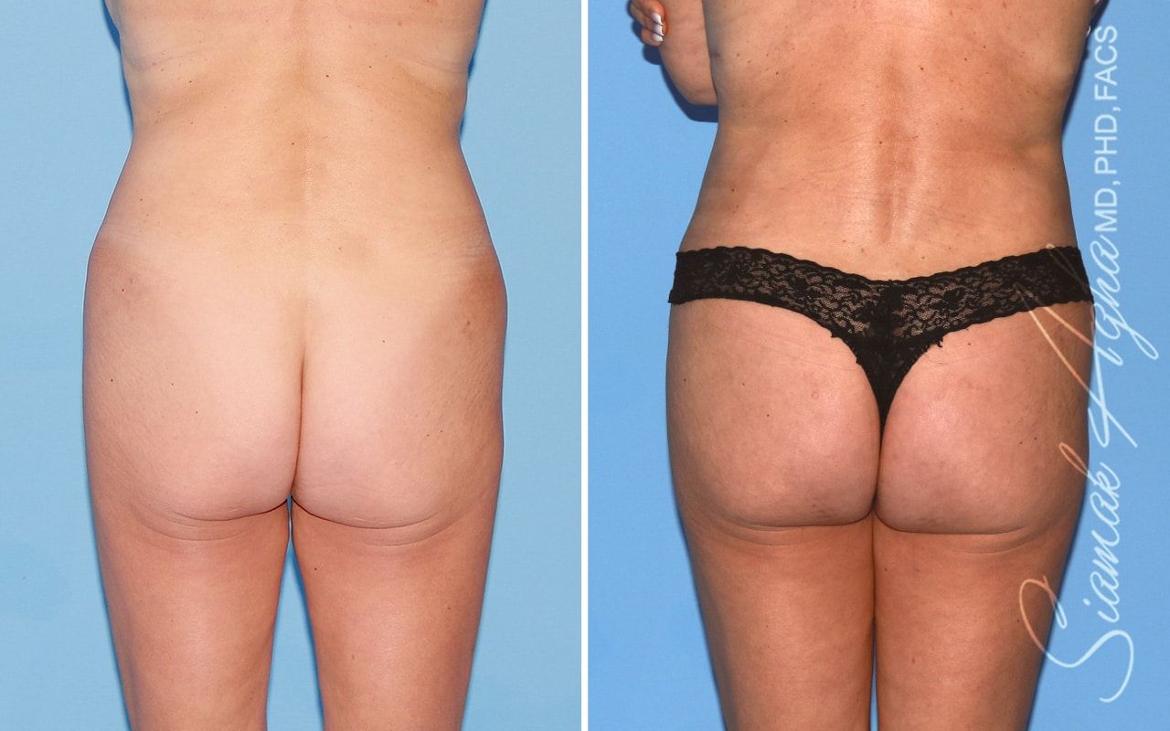 Brazilian Butt Lift Before & After