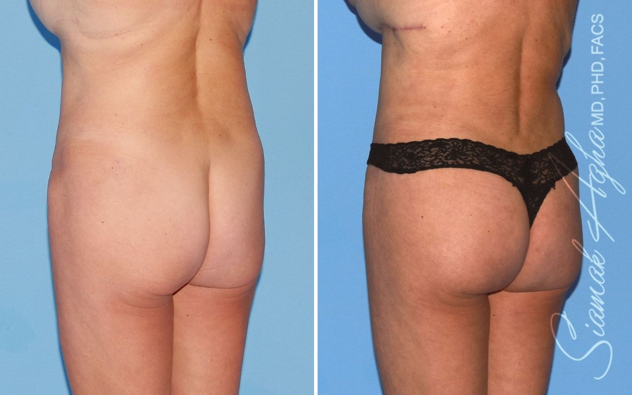Brazilian Butt Lift Before & After