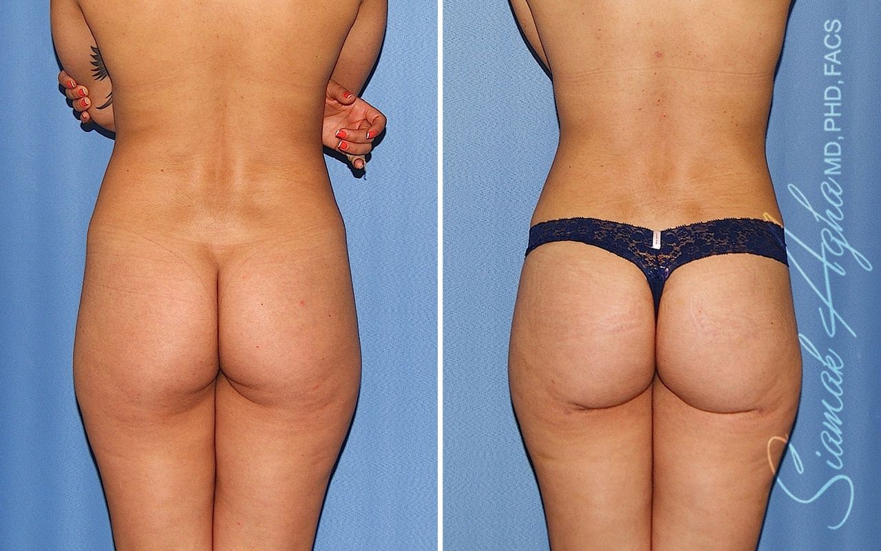 Brazilian Butt Lift Before & After