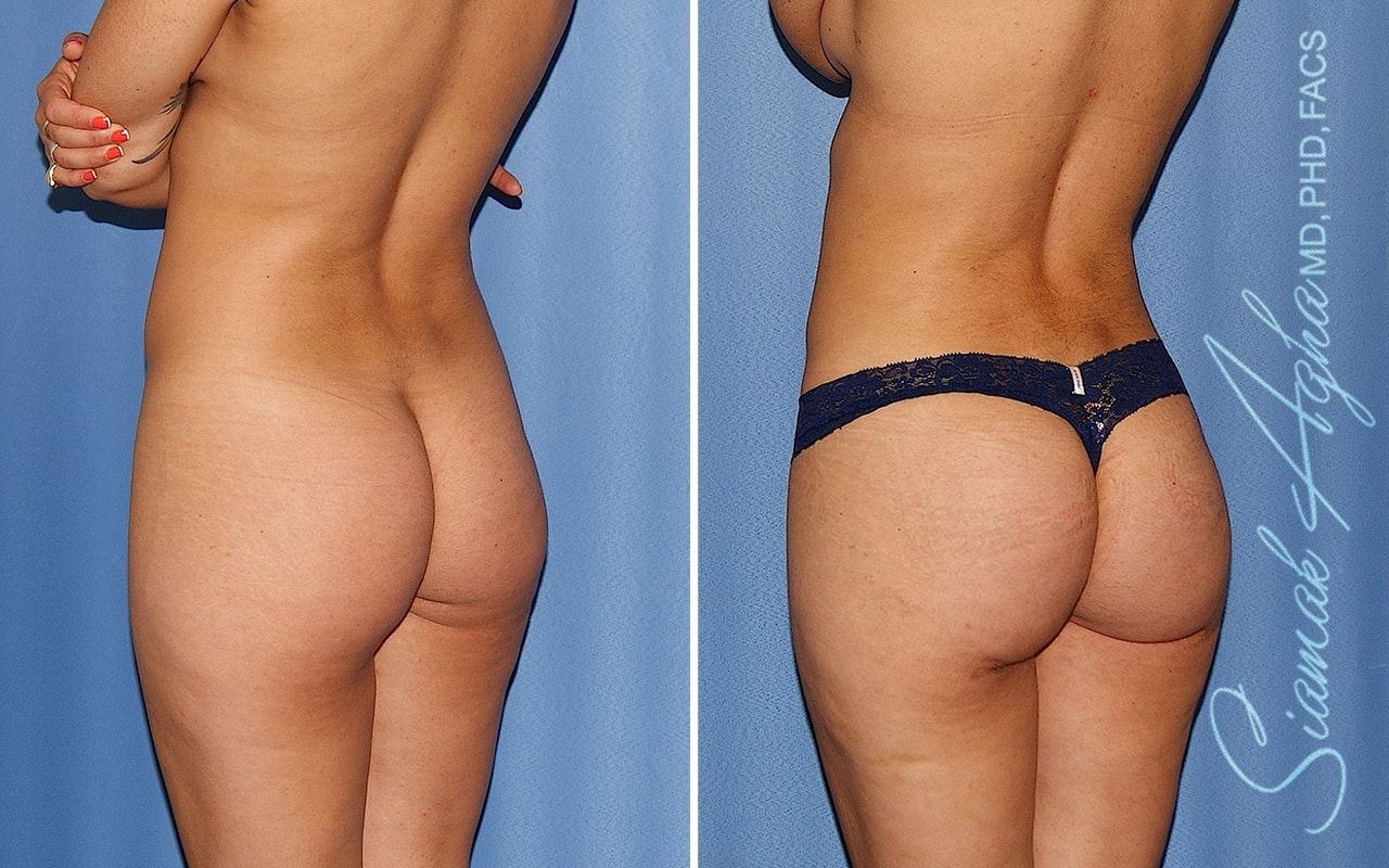 Brazilian Butt Lift Before & After