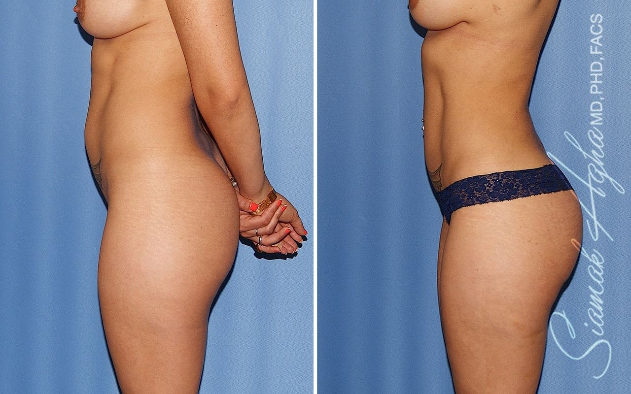 Brazilian Butt Lift Before & After