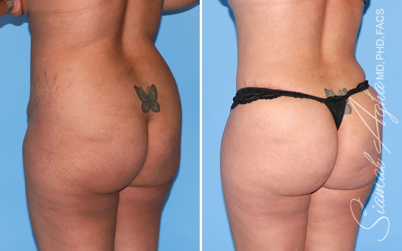 Brazilian Butt Lift Before & After