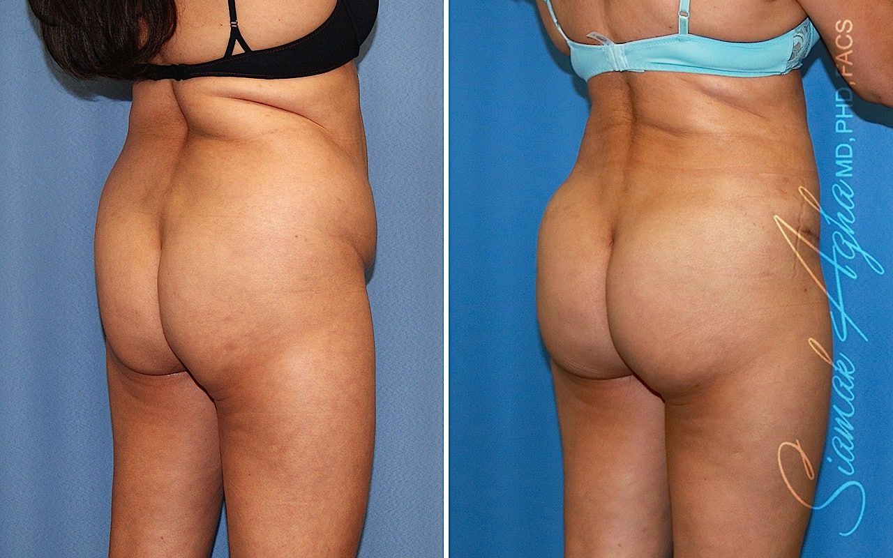 Brazilian Butt Lift Before & After