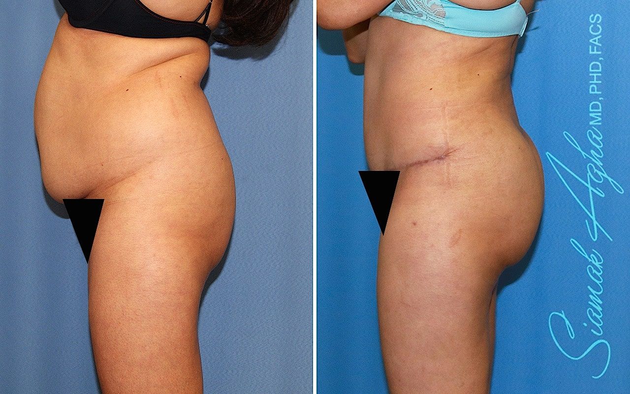 Brazilian Butt Lift Before & After