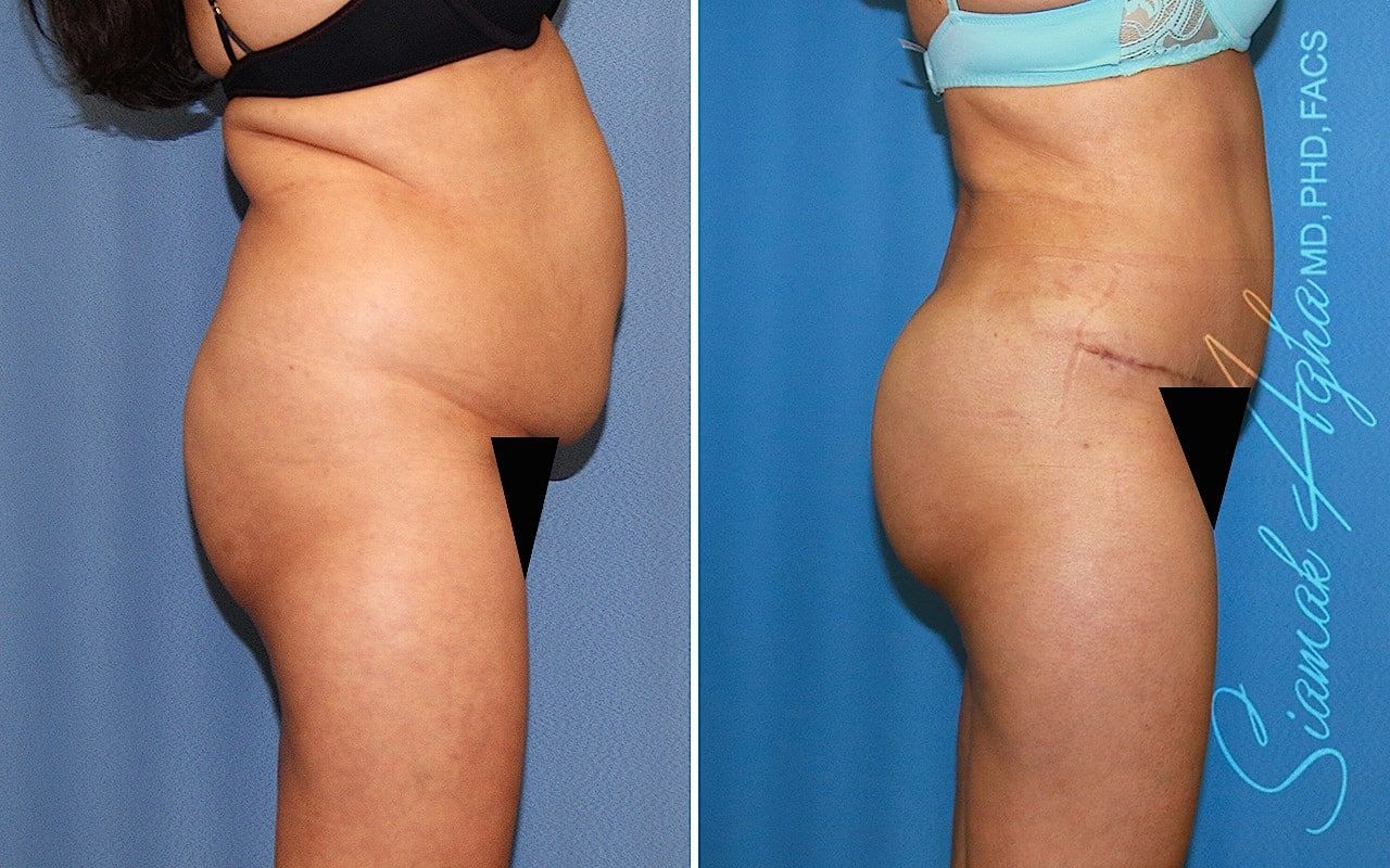 Brazilian Butt Lift Before & After