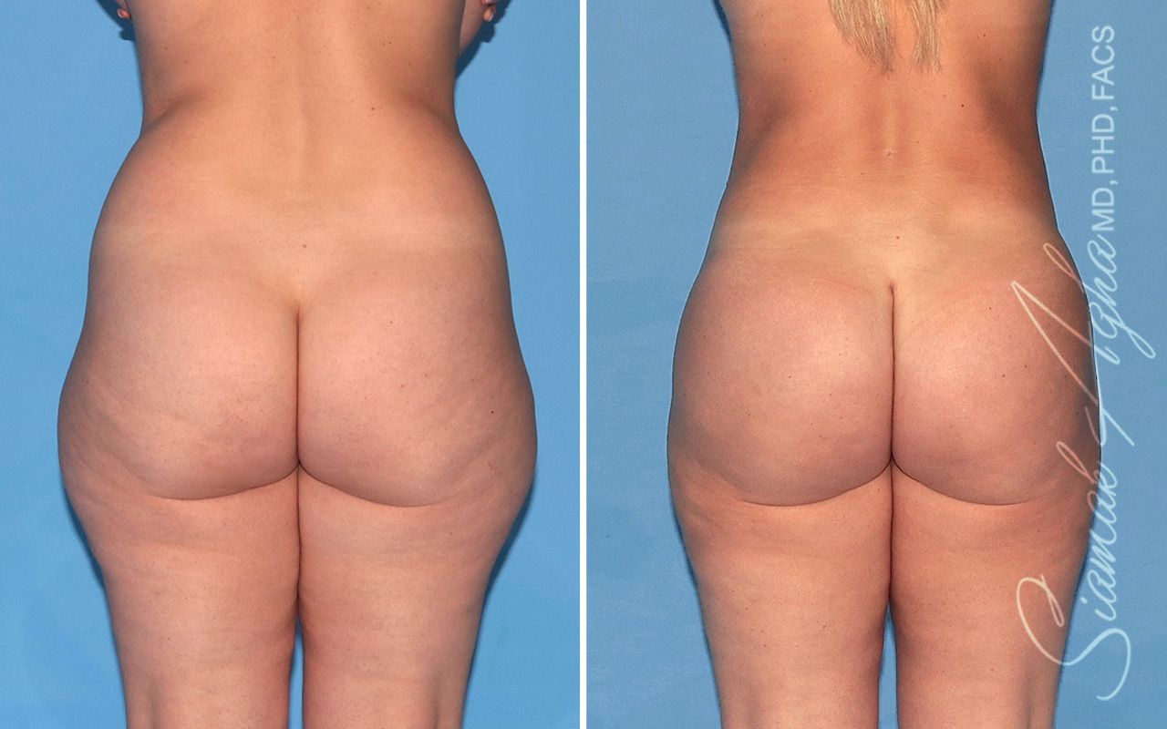 Brazilian Butt Lift Before & After