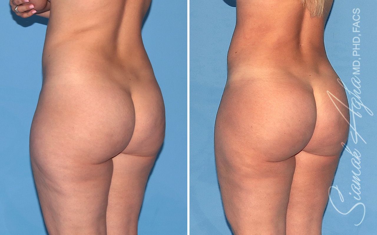 Brazilian Butt Lift Before & After