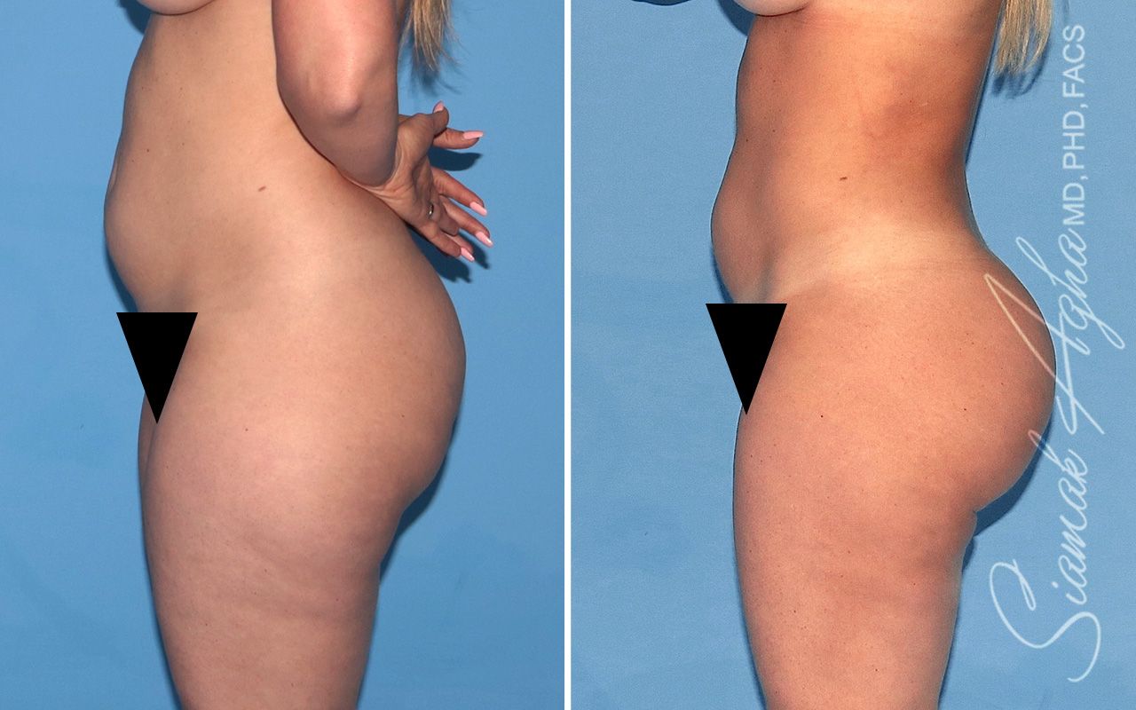 Brazilian Butt Lift Before & After