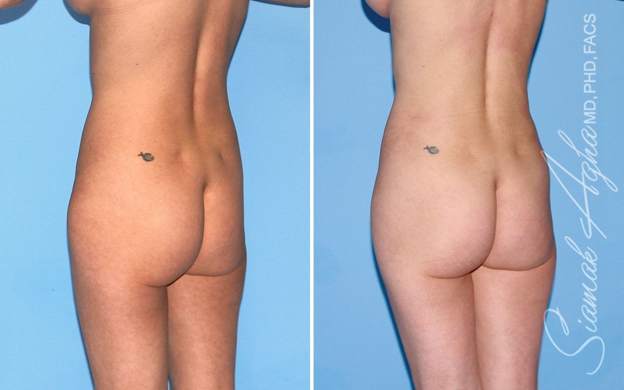 Brazilian Butt Lift Before & After