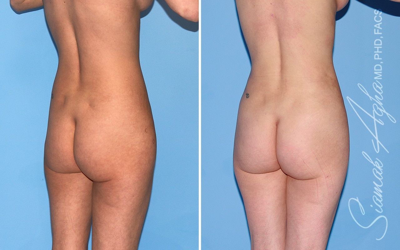 Brazilian Butt Lift Before & After