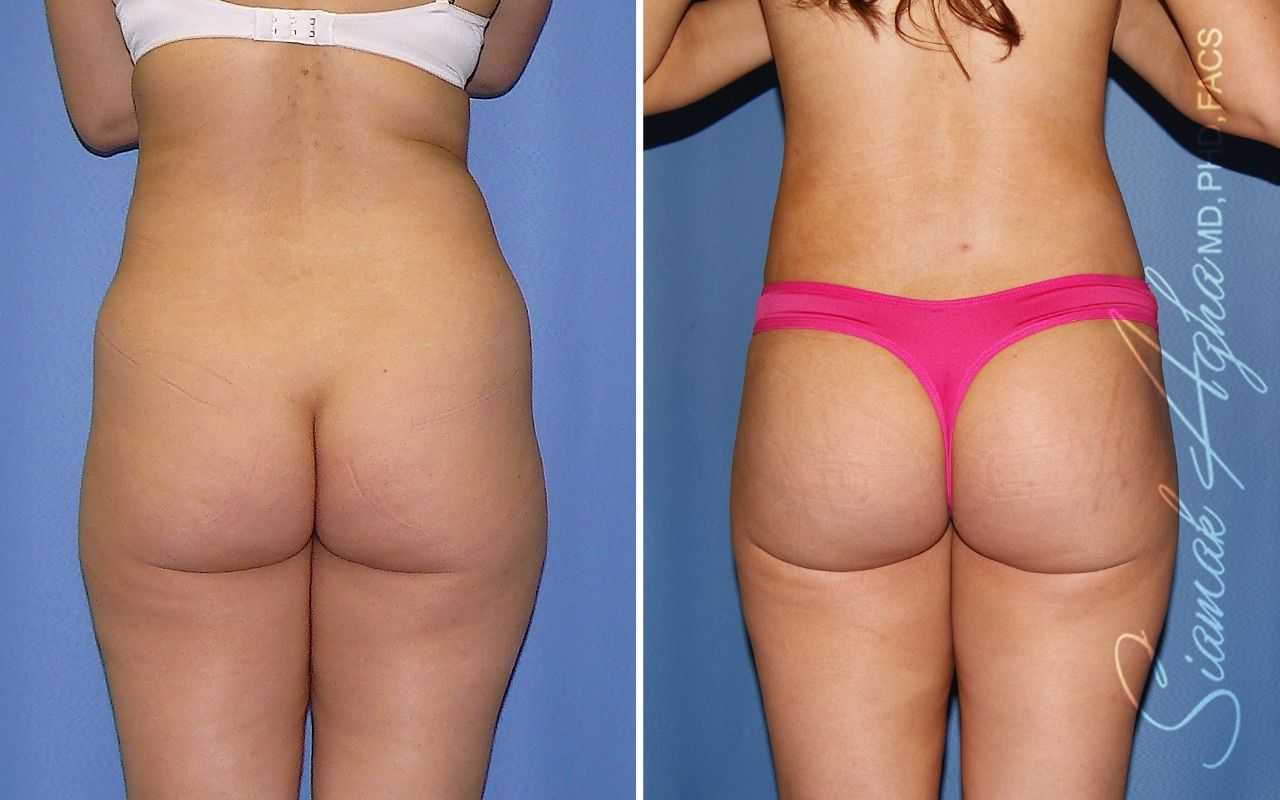 Brazilian Butt Lift Before & After