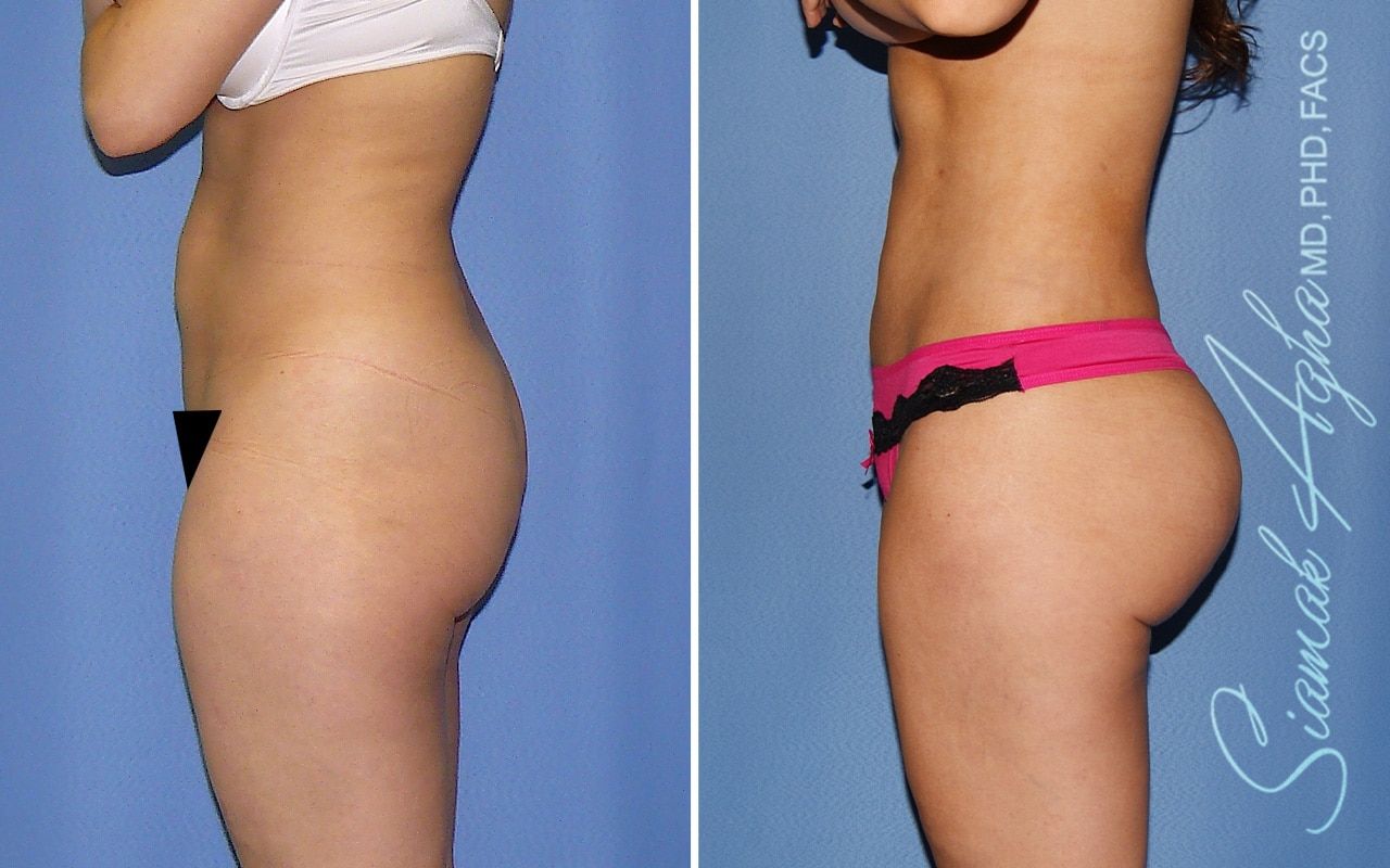 Brazilian Butt Lift Before & After