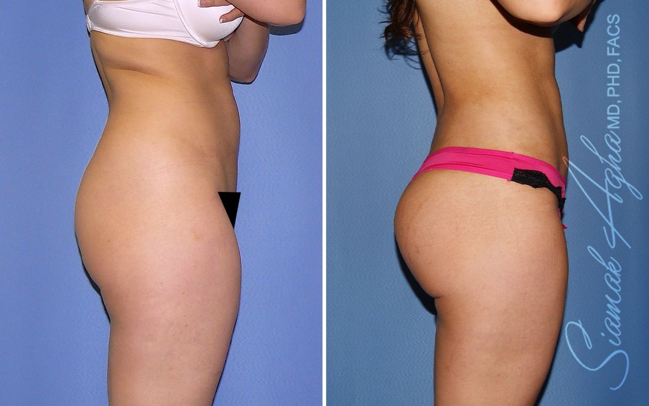 Brazilian Butt Lift Before & After