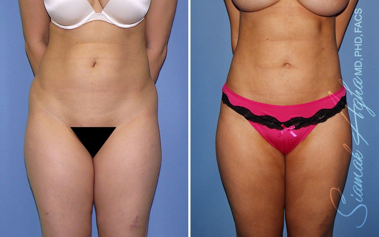 Brazilian Butt Lift Before & After