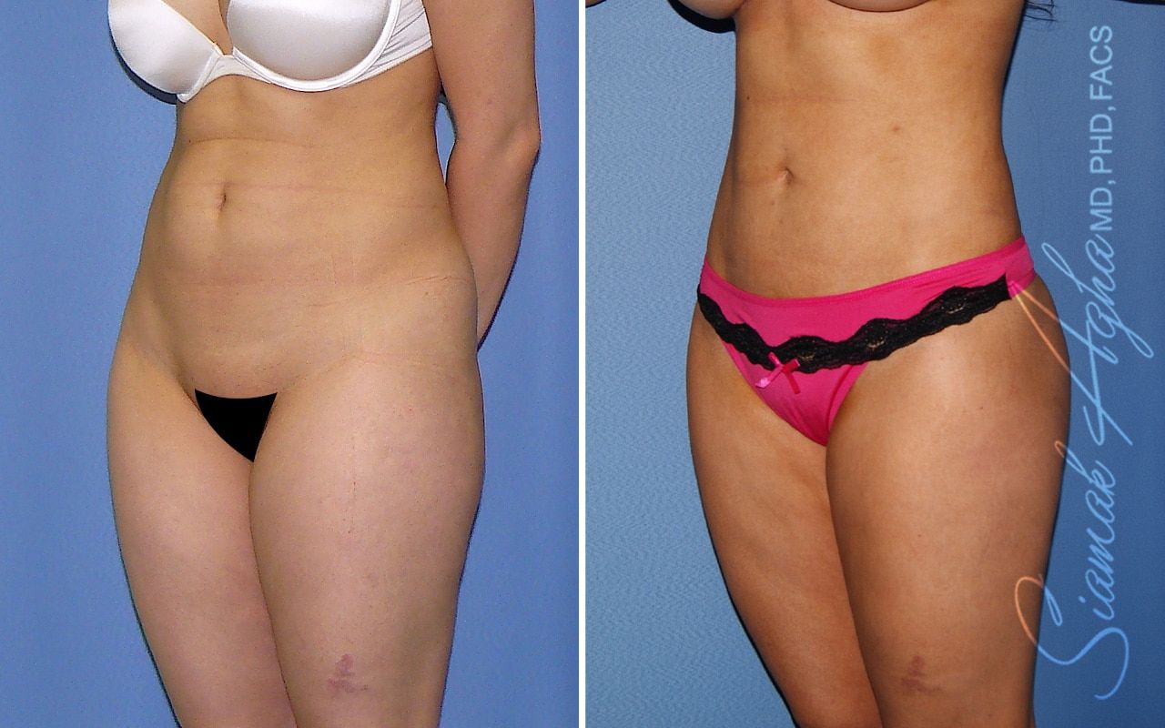 Brazilian Butt Lift Before & After