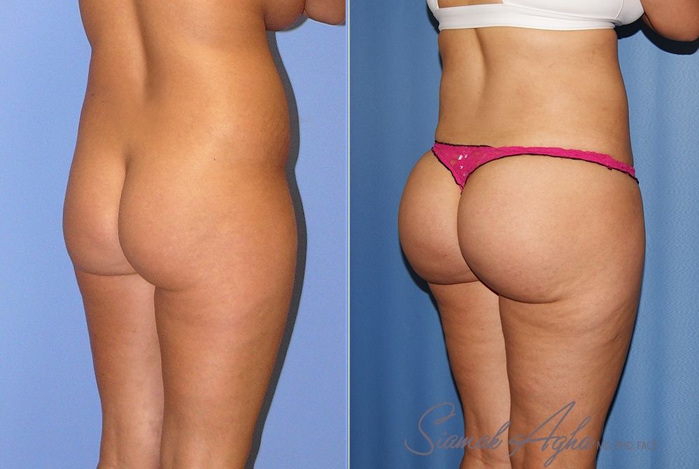 Brazilian Butt Lift Before & After