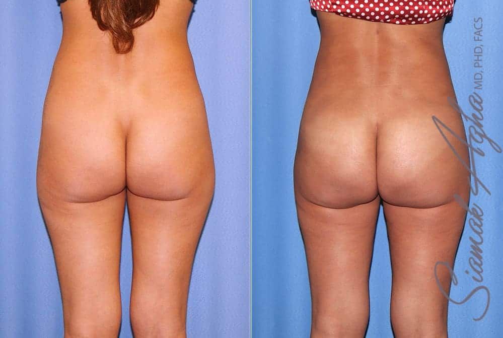 Brazilian Butt Lift Before & After
