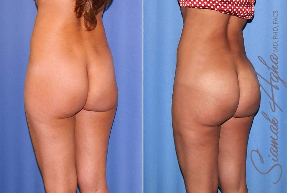 Brazilian Butt Lift Before & After
