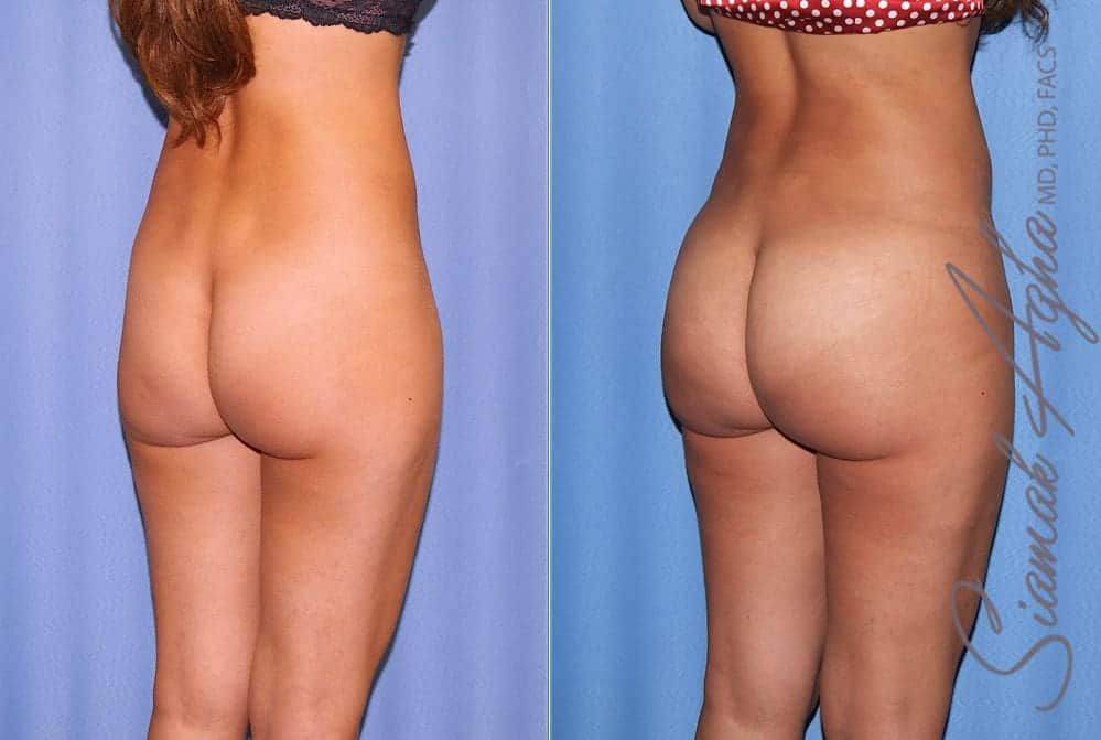 Brazilian Butt Lift Before & After