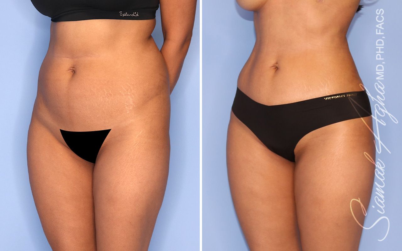 Brazilian Butt Lift Before & After