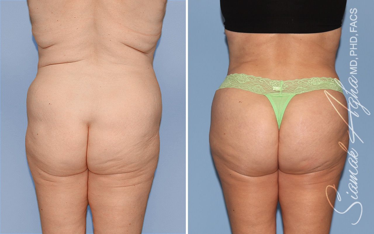 Brazilian Butt Lift Before & After