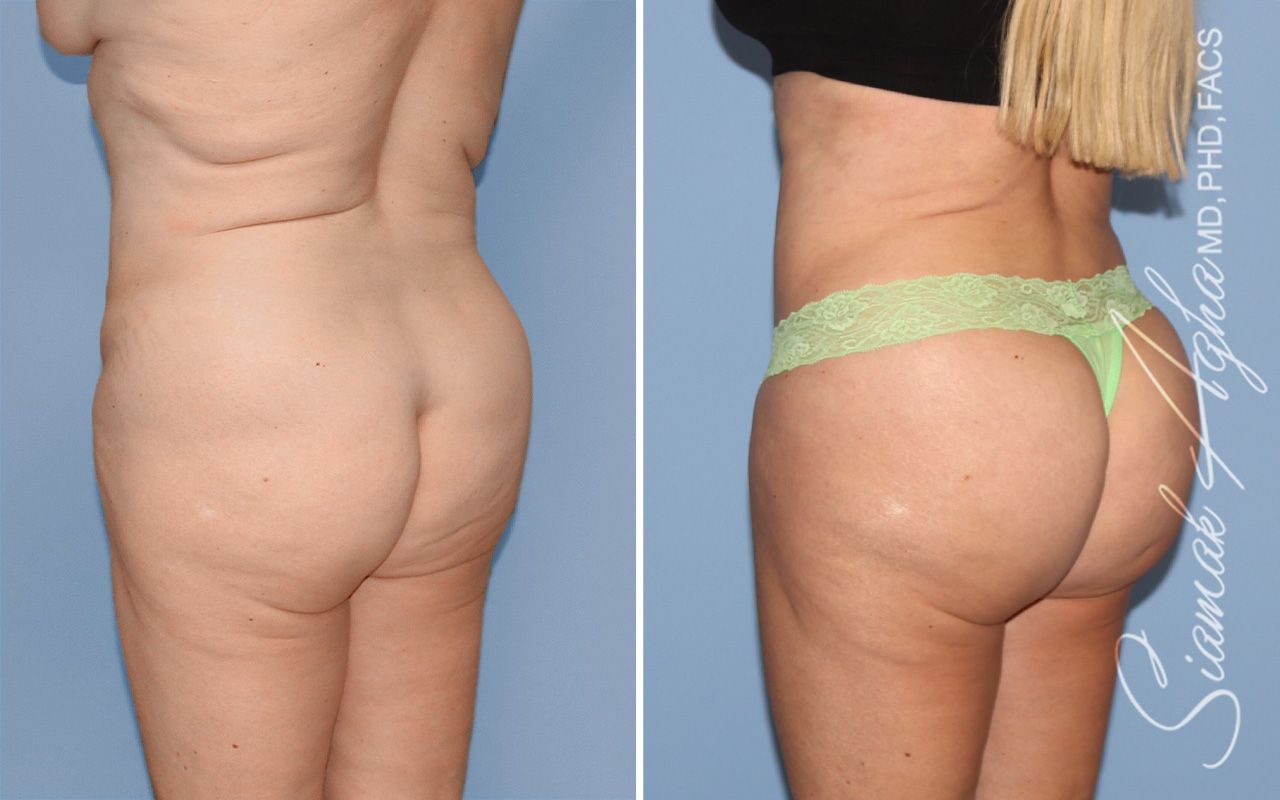 Brazilian Butt Lift Before & After