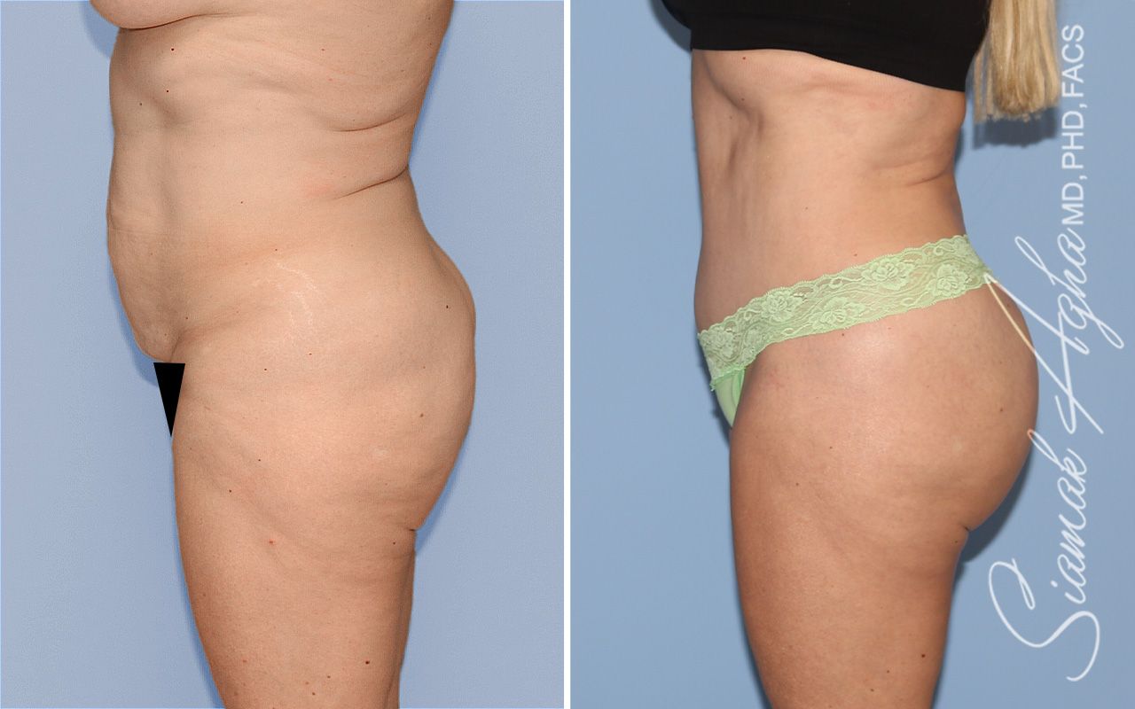 Brazilian Butt Lift Before & After