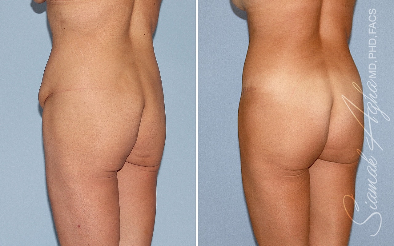 Brazilian Butt Lift Before & After