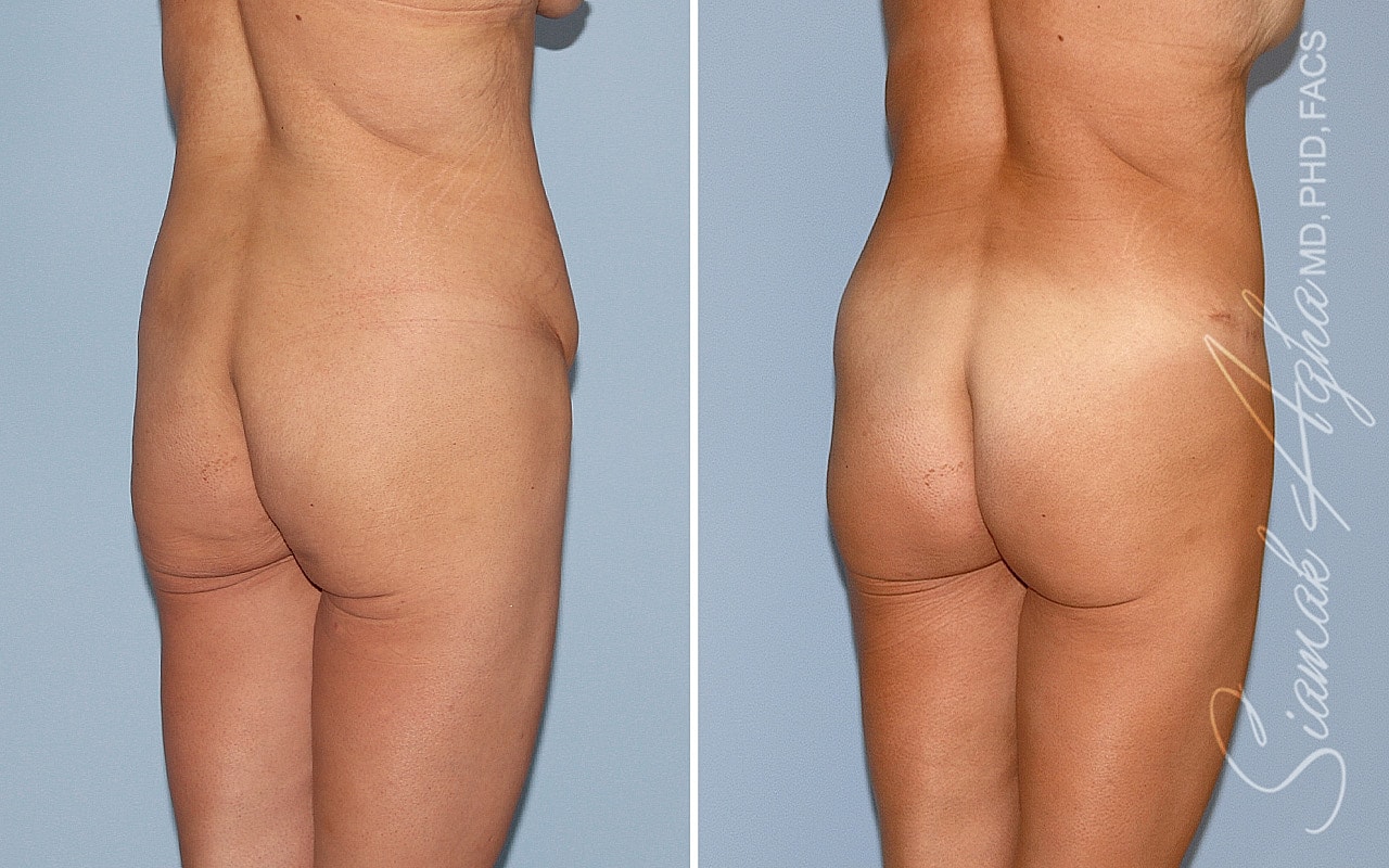 Brazilian Butt Lift Before & After