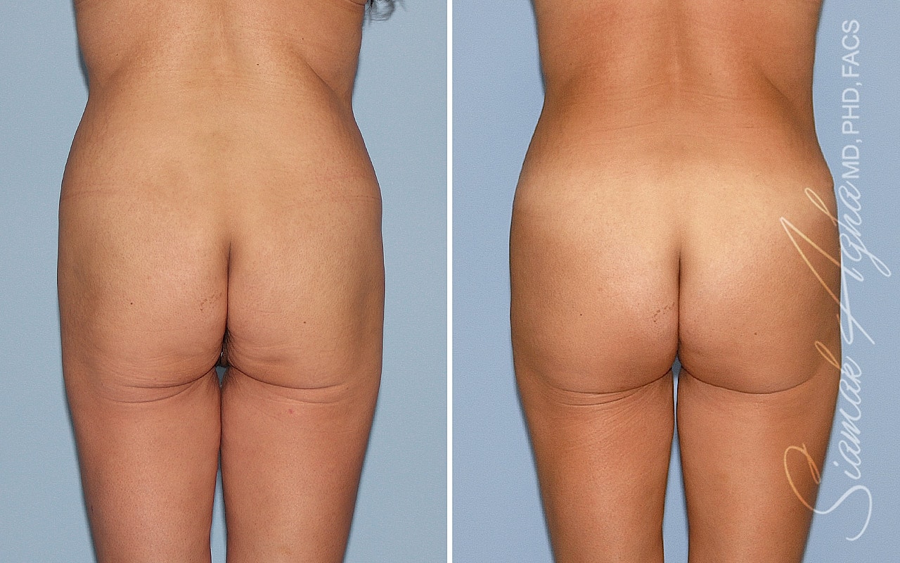 Brazilian Butt Lift Before & After