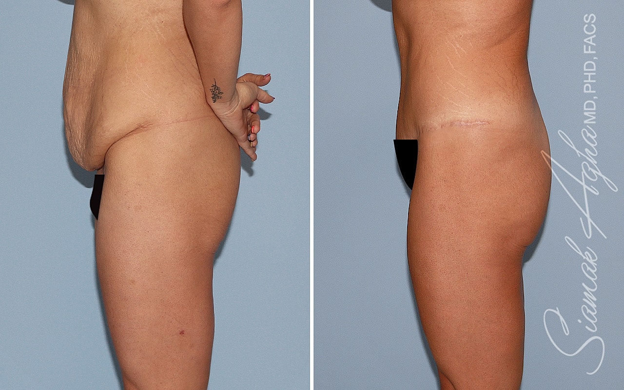 Brazilian Butt Lift Before & After