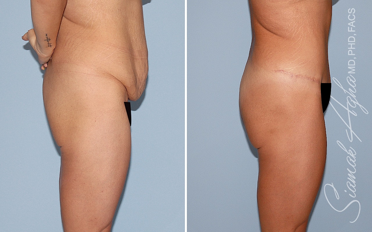 Brazilian Butt Lift Before & After
