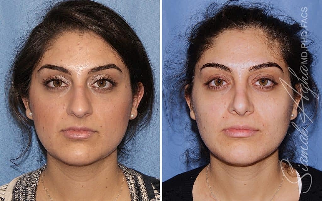 Rhinoplasty Before & After