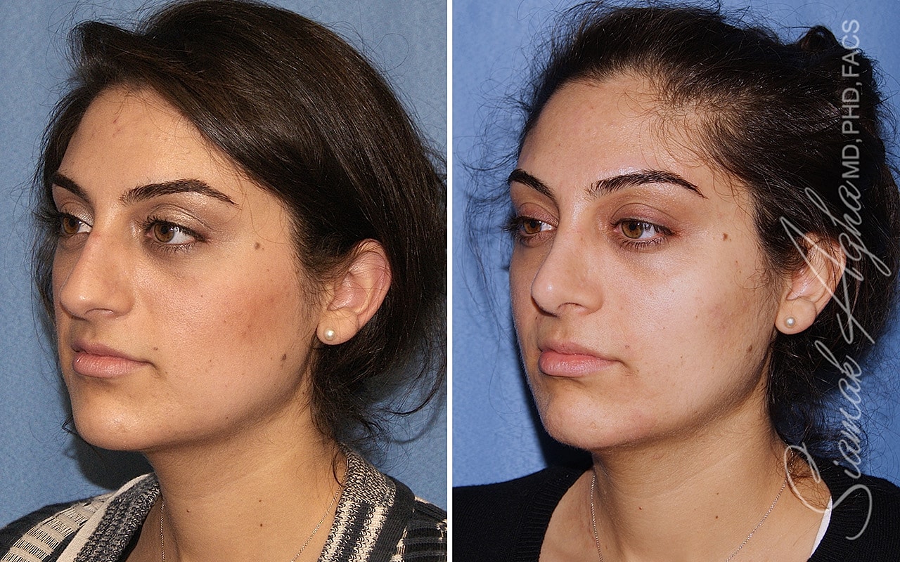 Rhinoplasty Before & After