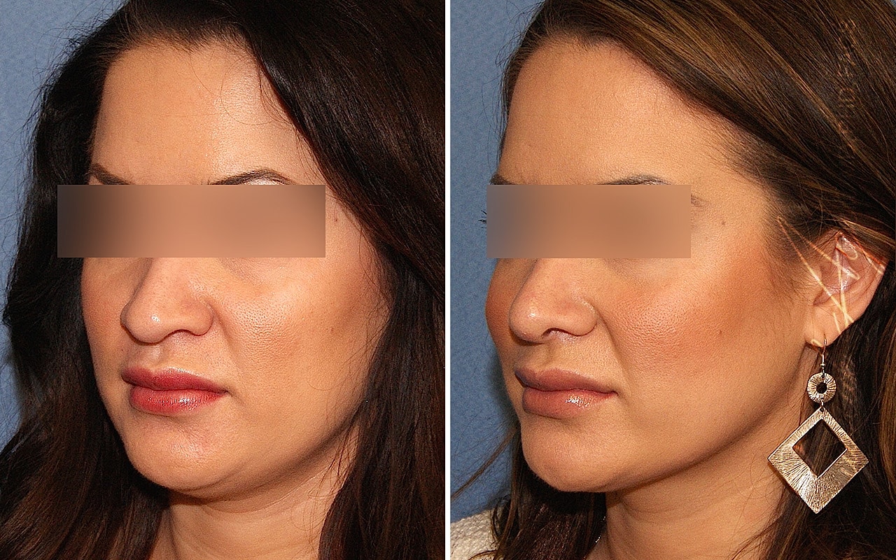 Rhinoplasty Before & After