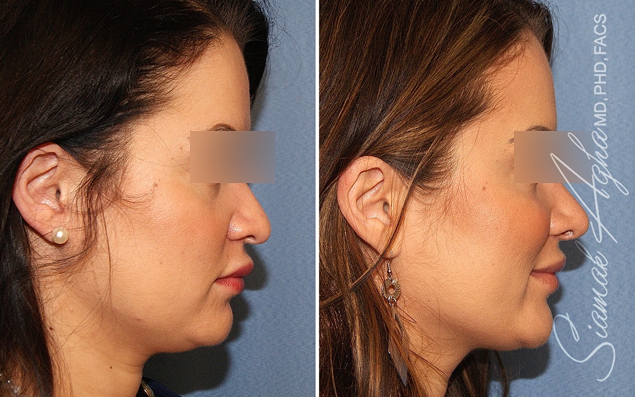 Rhinoplasty Before & After