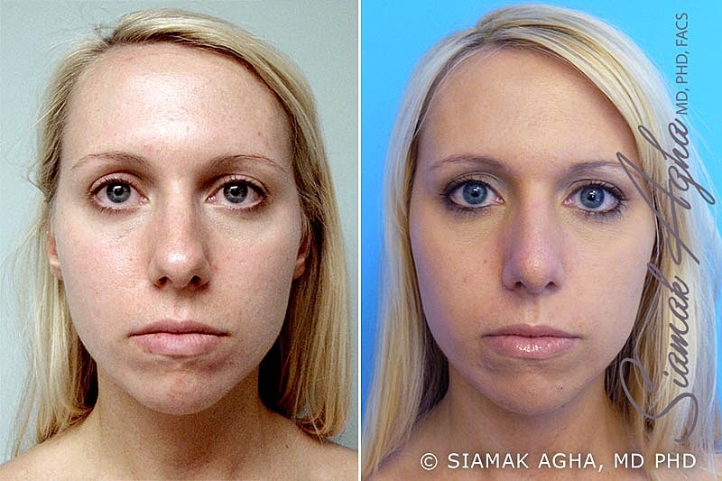 Rhinoplasty Before & After