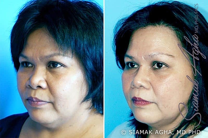 Rhinoplasty Before & After