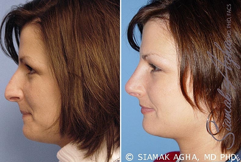 Rhinoplasty Before & After